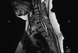 颈椎 MRI 显示（矢状位 T2 像）：严重多节段椎间盘退行性变，但无明显脊髓受压（即：无畸形，也无内在 T2 改变）