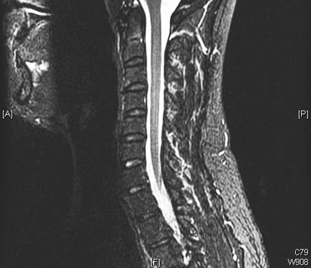 颈椎 MRI（矢状位 T2）显示轻度退行性关节病和椎间盘突出