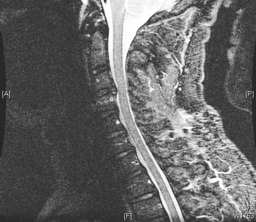 颈椎 MRI（矢状位 T2）显示中度退行性关节病，但无明显脊髓压迫