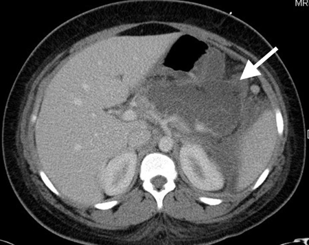 对出现由胆源性胰腺炎导致中上腹痛的青少年女性进行 CT 扫描。大量液体蓄积在胰床上（白色箭头），并且胰腺未强化提示胰腺液化性坏死