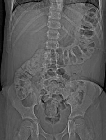 存在急性、严重腹痛的年幼男童的腹平片检查结果提示粪便遍及结肠与直肠。